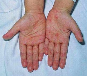 Biểu hiện lạ của bàn tay, bieu hien la cua ban tay