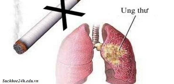 Bệnh ung thư phổi do hút thuốc lá gây nên, benh ung thu phoi do hut thuoc la gay nen